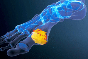 Gout Treatment: Managing Symptoms and Improving Quality of Life